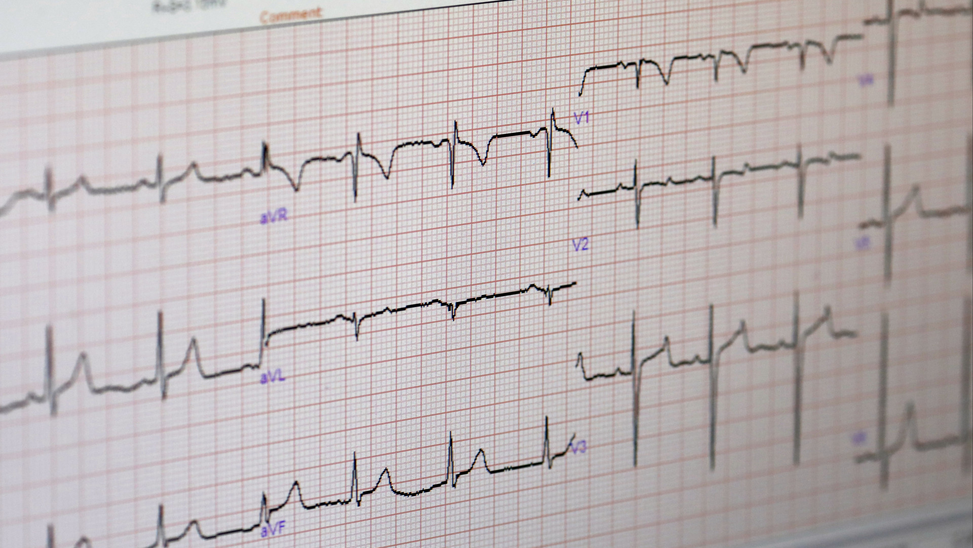 Met een electrocardiogram kan men zien hoe een hart functioneert