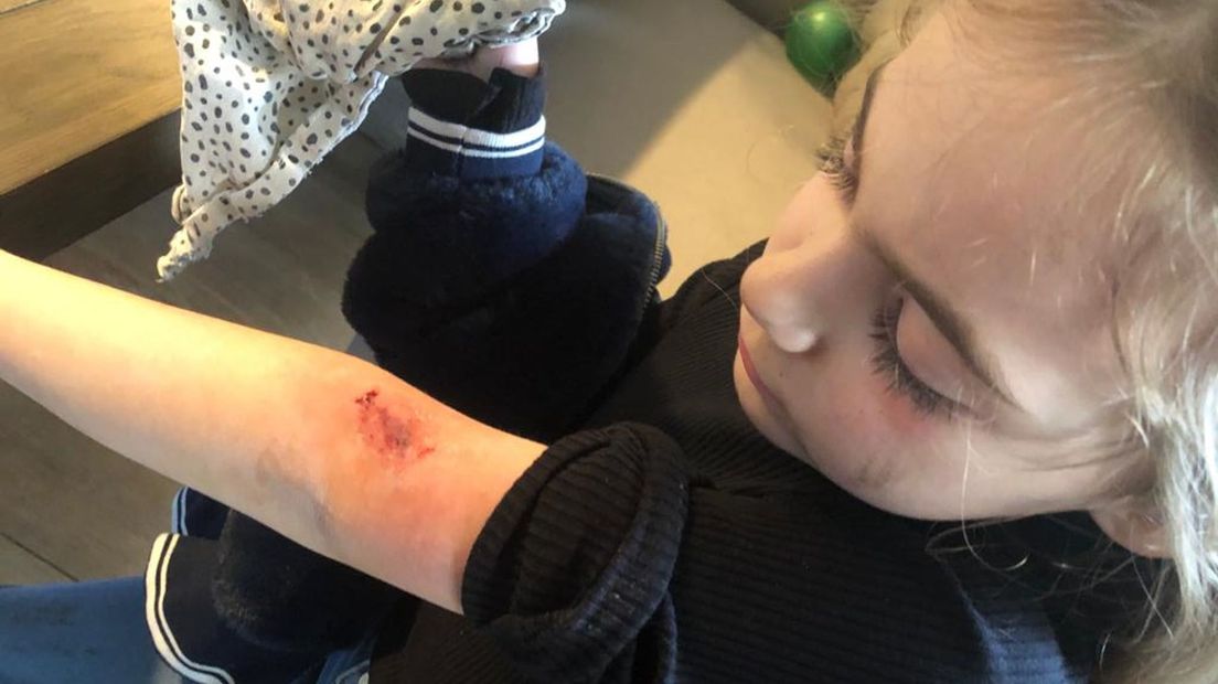 De bijtwond van Valentina