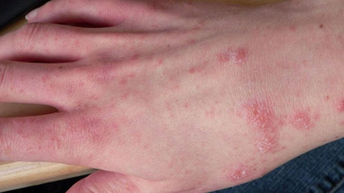 Scabies outbreak among students: “A lot of stress because the treatments don’t work”