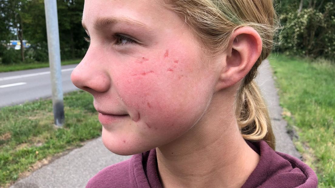 Eigenaar bijtende hond moet alsnog schadevergoeding betalen aan aangevallen meisje - RTV Noord