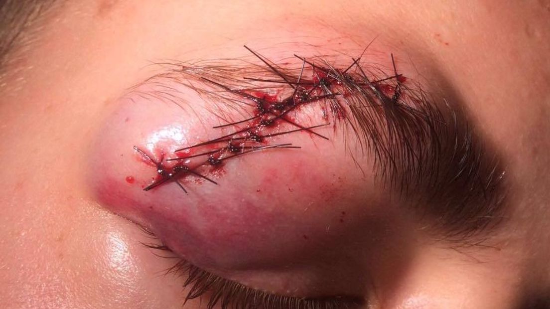Jongen (14) flink toegetakeld door onbekende
