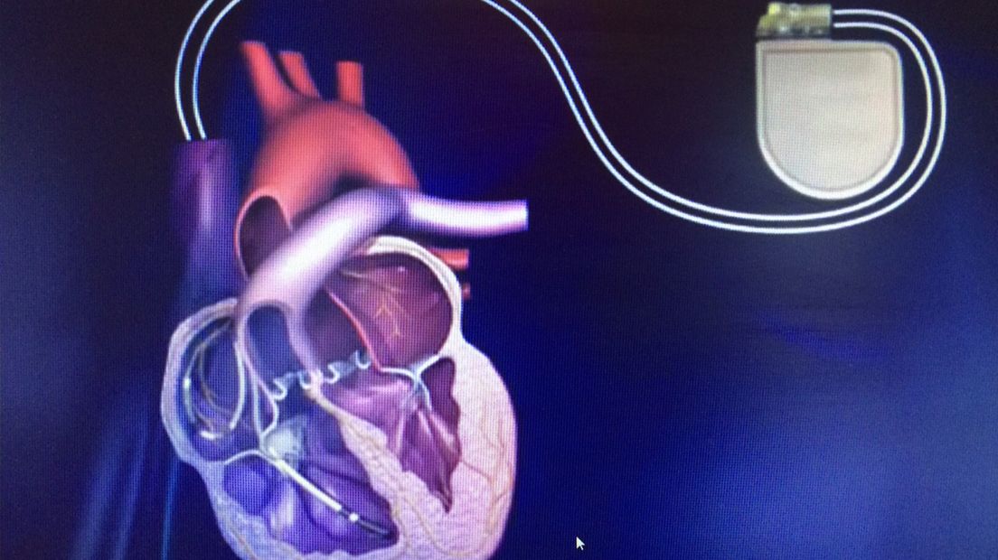 Hartpatiënt maakt handige app voor mensen met inwendige defibrillator (ICD) Omroep West