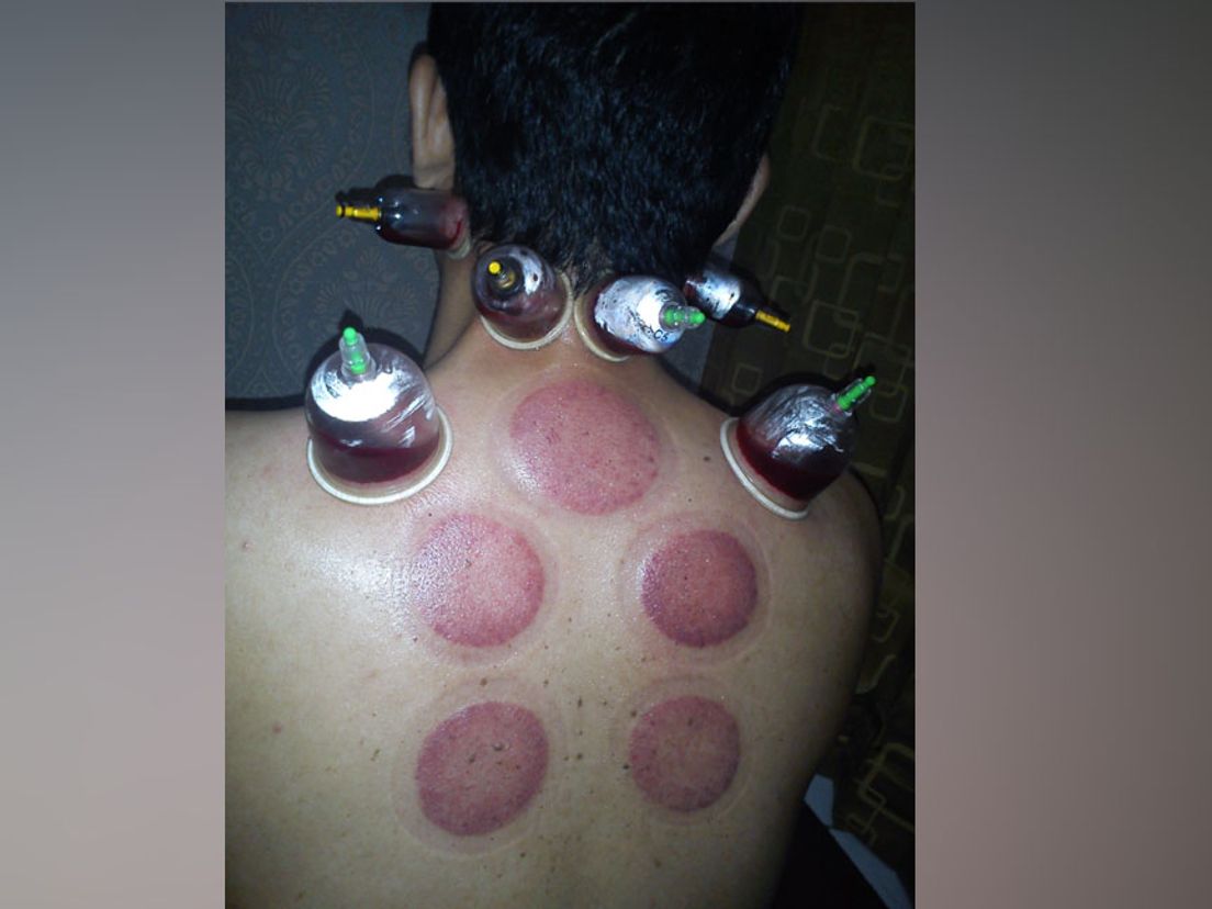 cupping