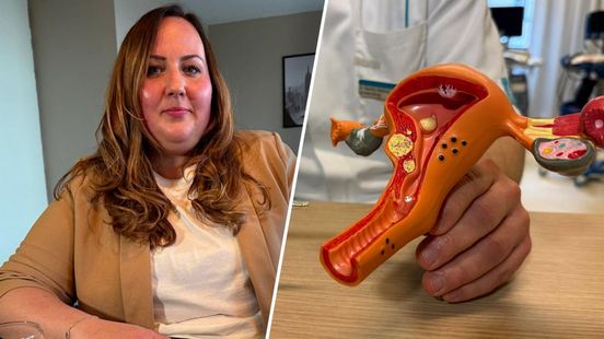 Gynaecologen onderzoeken nieuwe pijnbehandeling bij endometriose