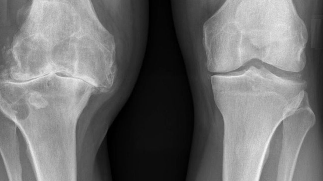 Als knieën door artrose zijn aangetast, is dat pijnlijk