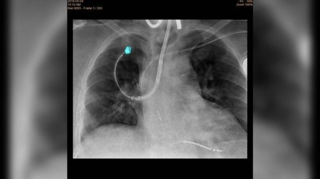 Röntgenfoto van de longen.