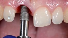 Zorgautoriteit onderzoekt gesjoemel bij tandarts Kerkrade