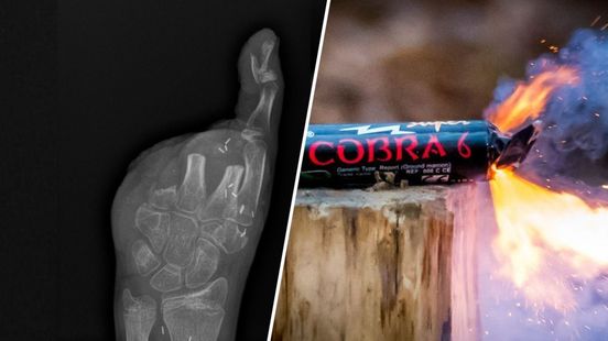 Tycho (13) is vier vingers kwijt door illegaal vuurwerk