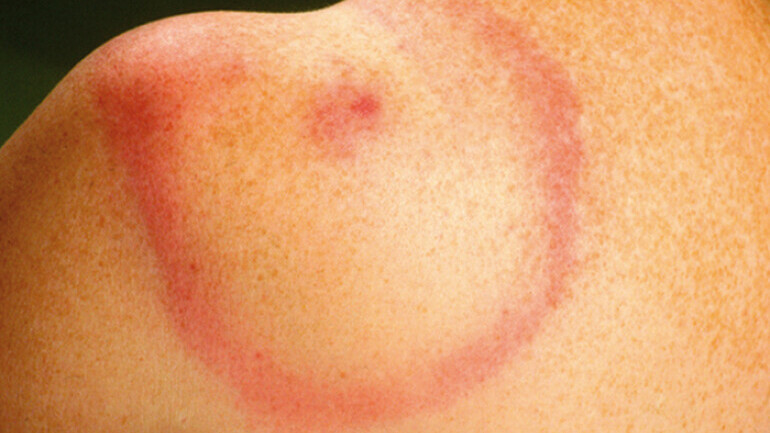 Steeds meer teken in de natuur. Wat moet je doen bij een tekenbeet