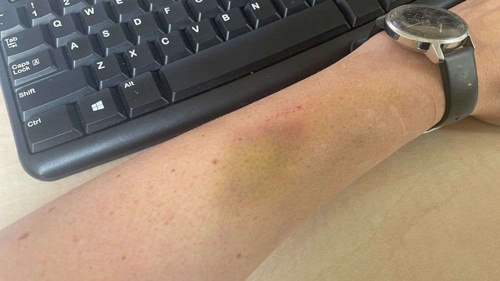 Waarom verandert een blauwe plek van kleur? - RTV Drenthe