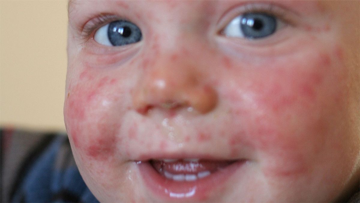 保育所が「ワクチン接種を受けていない子どもの保育所利用を拒否せよ」と呼びかける