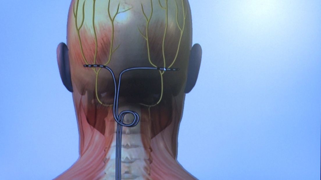 Elektroden moeten de pijn onderdrukken