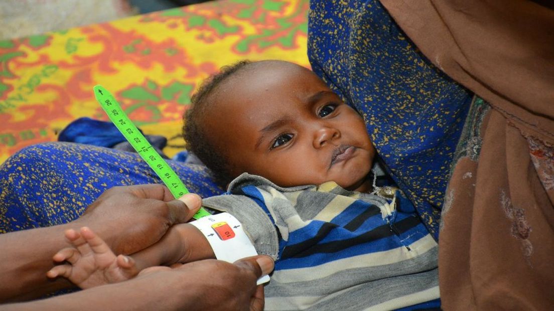 ondervoeding in Ethiopië