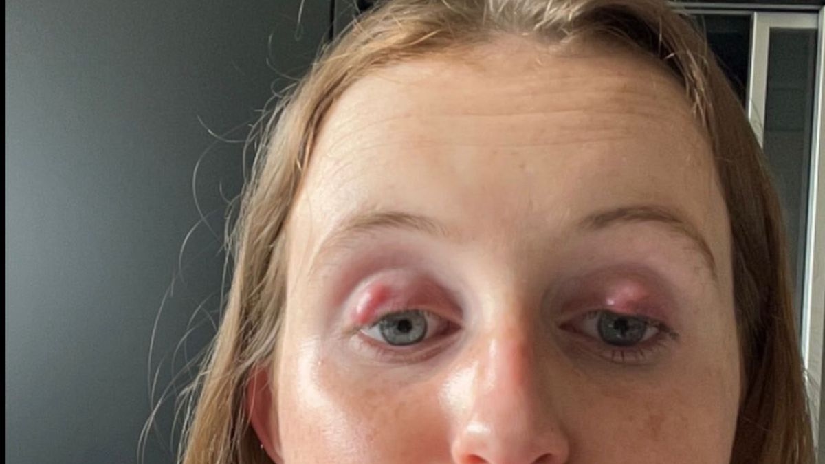 Milou gebruikte drie maanden wimperserum en heeft nu chronisch oogontsteking