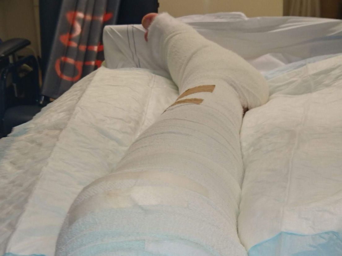 Het been van Chris dat niet werd geamputeerd, was op meerdere plekken gebroken.
