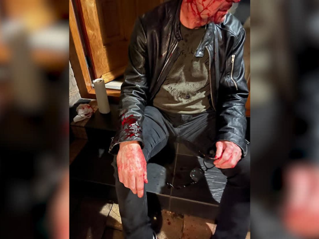 “In mijn neus zit een deukje. Daar is naar gekeken, maar ik laat het voor wat het is.”