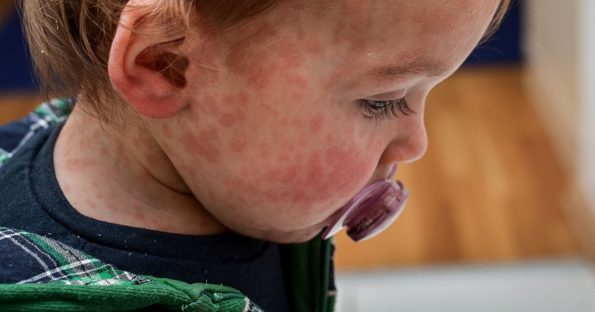 Bible Belt could pose measles risk for Frislan: 'Prevent him'