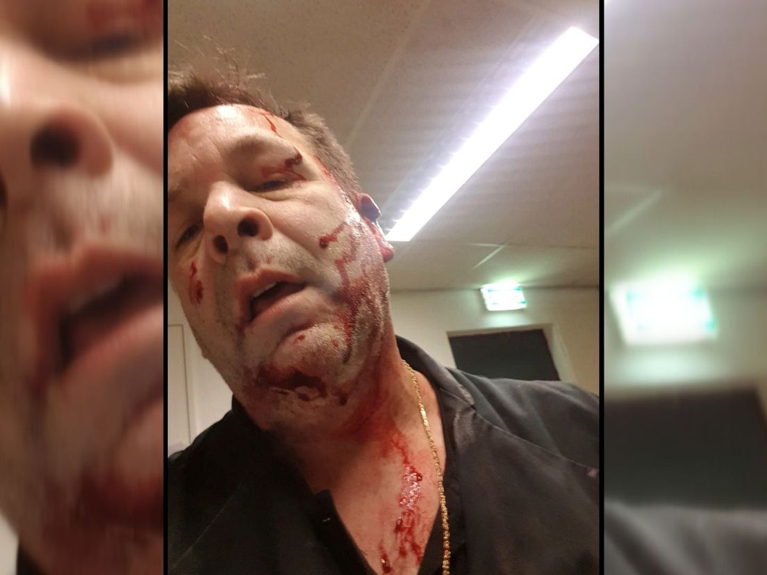 Bakker Jeroen Luijten maakt selfie van zijn verwondingen