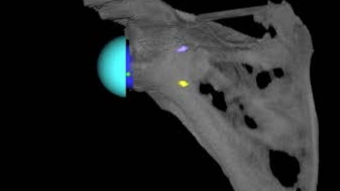 Gelre ziekenhuizen: betere schouderprothese met 3D-simulatie