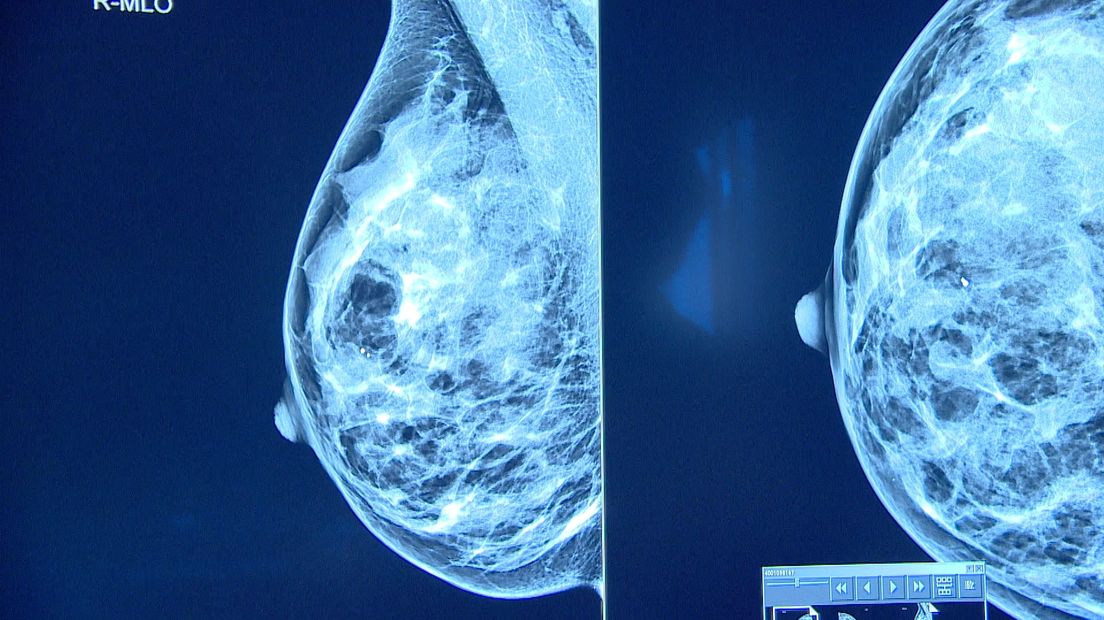 Nieuw borstkankercentrum moet sneller diagnose stellen