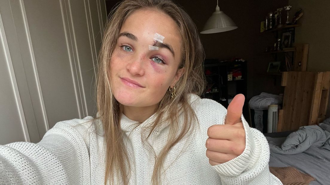 Jip Dicke hield twaalf hechtingen over aan de bal in haar gezicht
