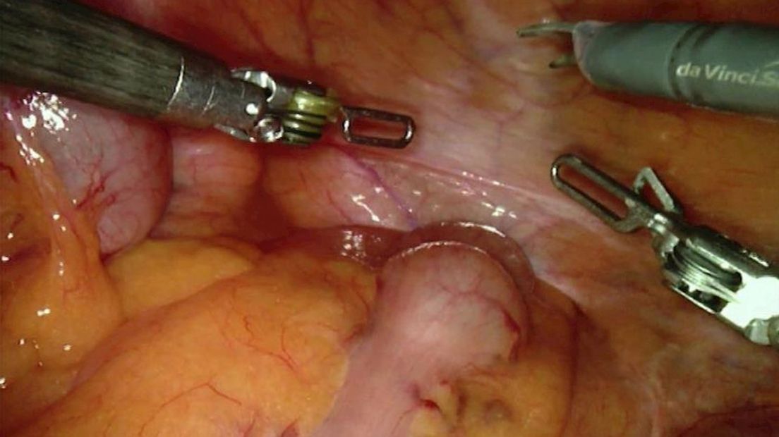 Prostaatoperatie in ZGT