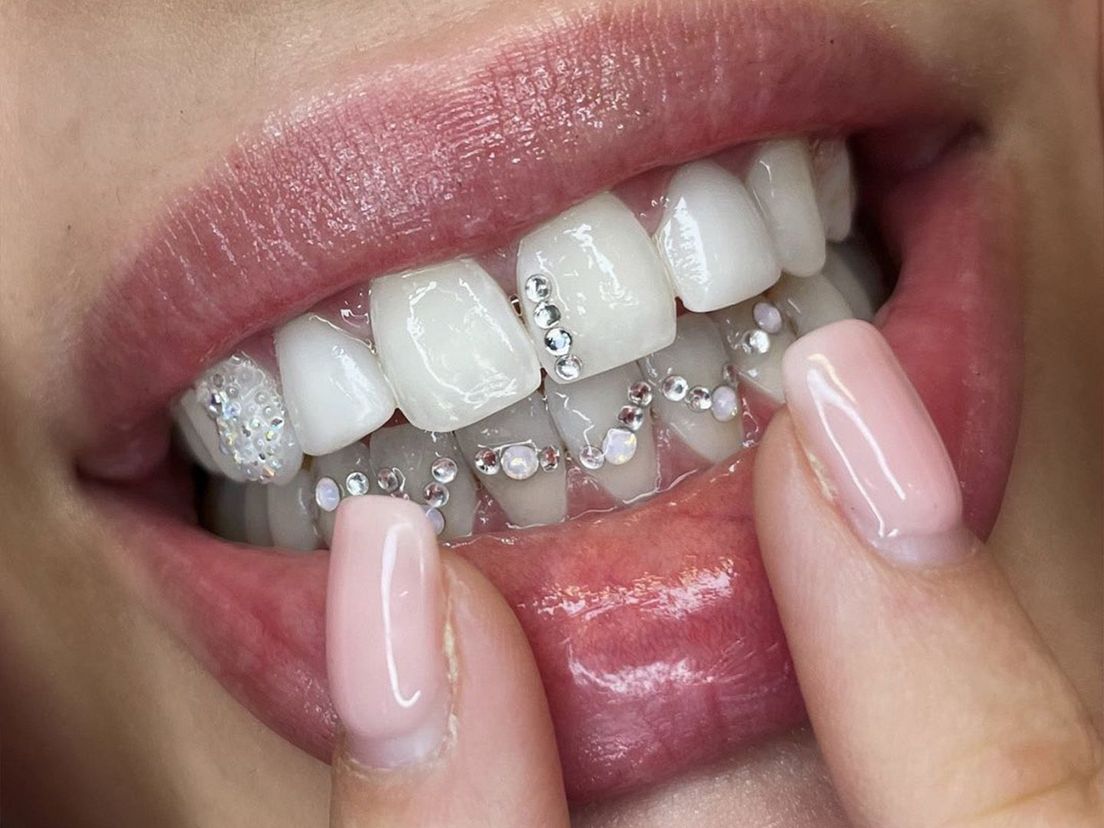 Toothgems