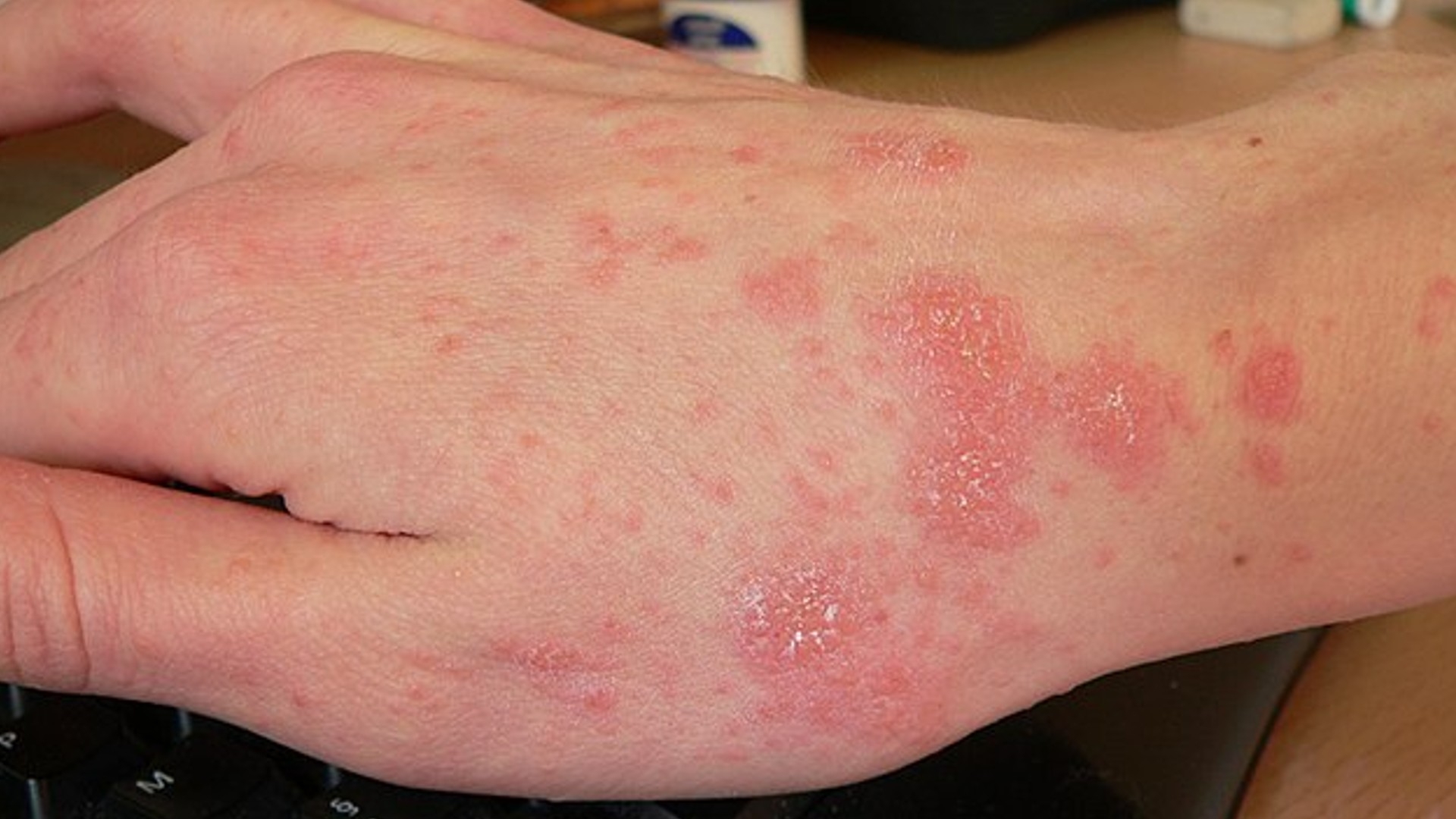 Understanding Scabies: Causes, Symptoms, And Treatment - World Today News