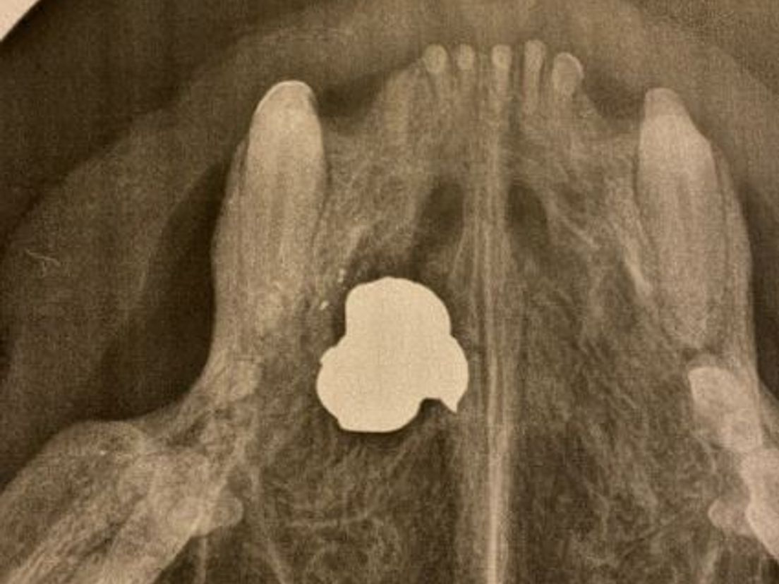 Röntgenfoto van Bullet, met de kogel als grote witte vlek