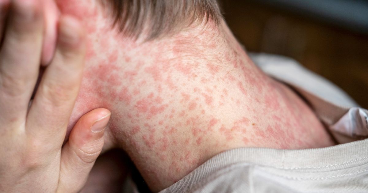 Measles in Friesland: Súdwest-Fryslân Resident Infected