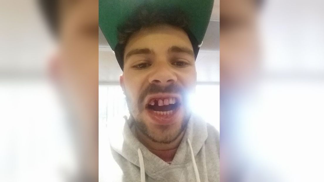 Dave Hartevelt mist een tand na de mishandeling | Eigen foto