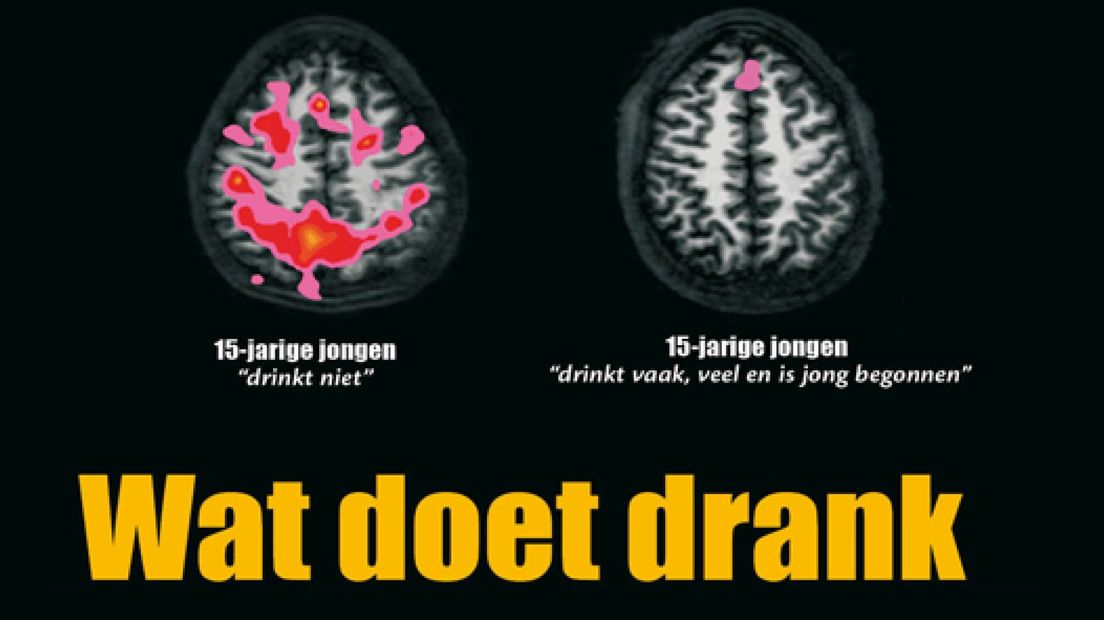 GGD verspreidt hersenscans pubers