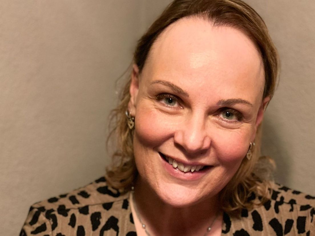 Mariëlle heeft een vorm van alopecia waarbij de kaalheid aan de voorkant begint.