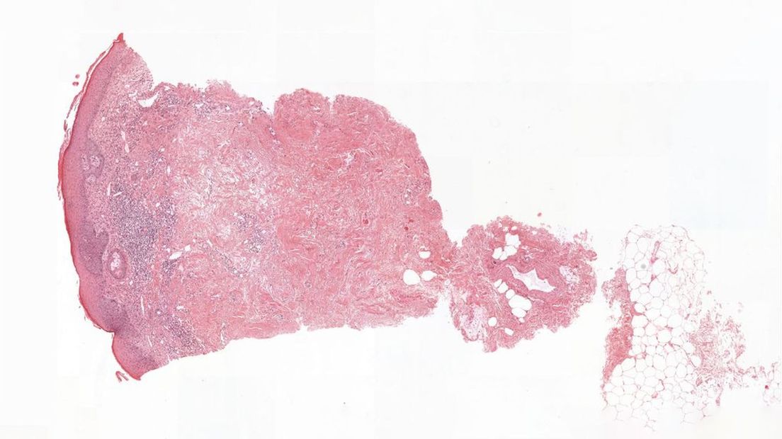 Huidkanker type basaalcelcarcinoom